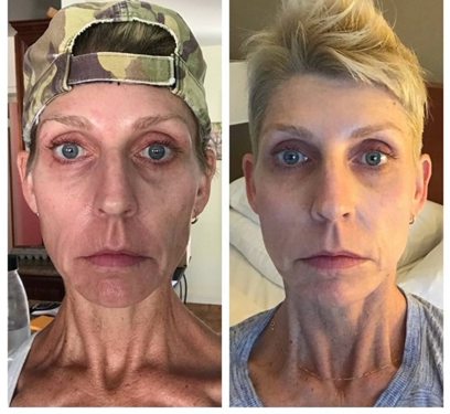 collagen-sculptra collagen-sculptra